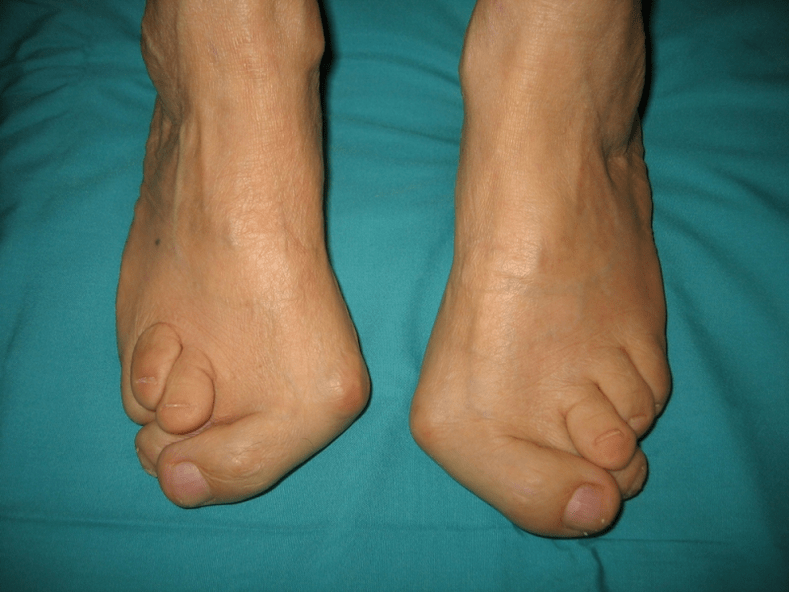 Deformity