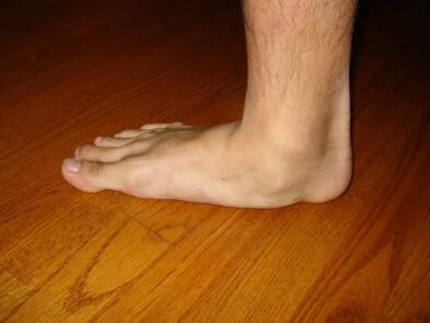 The risk of deformation