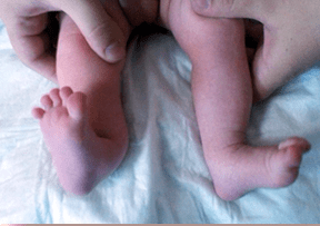 Valgus deformation in children's symptoms