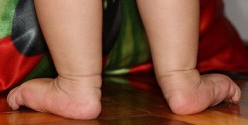 Deformity