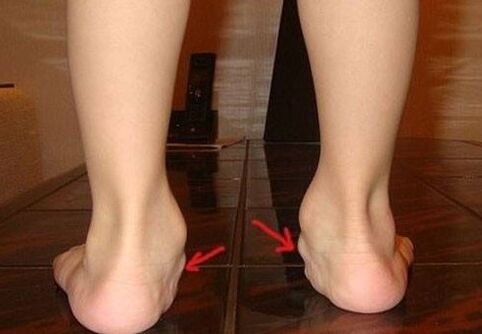 Deformation of the leg valgus in children