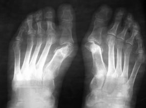 Indications for operations under the foot valgus