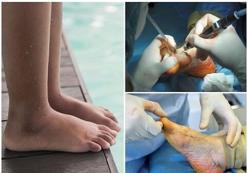 Small Surgical Treatment -invasive