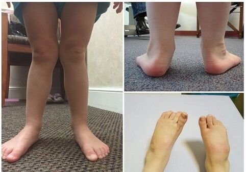 Valgus deformation in children