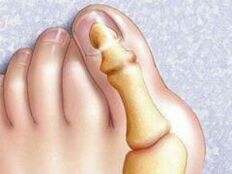Deformation of Hallux Valgus