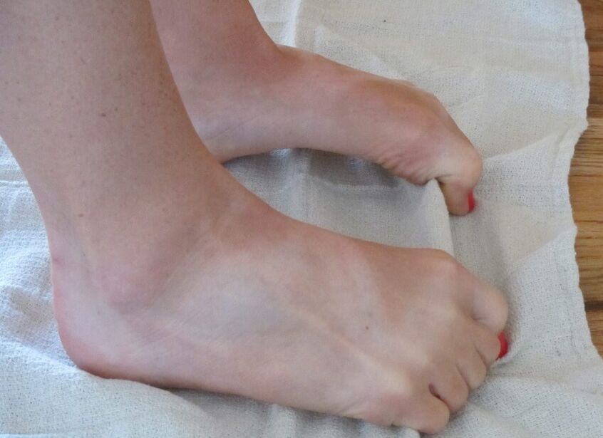 Exercise for feet with deformed big toe