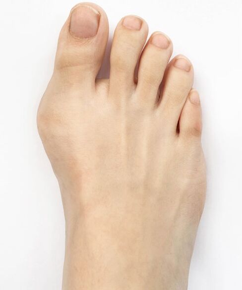 hallux valgus before using Hondro Sol Valgus spray